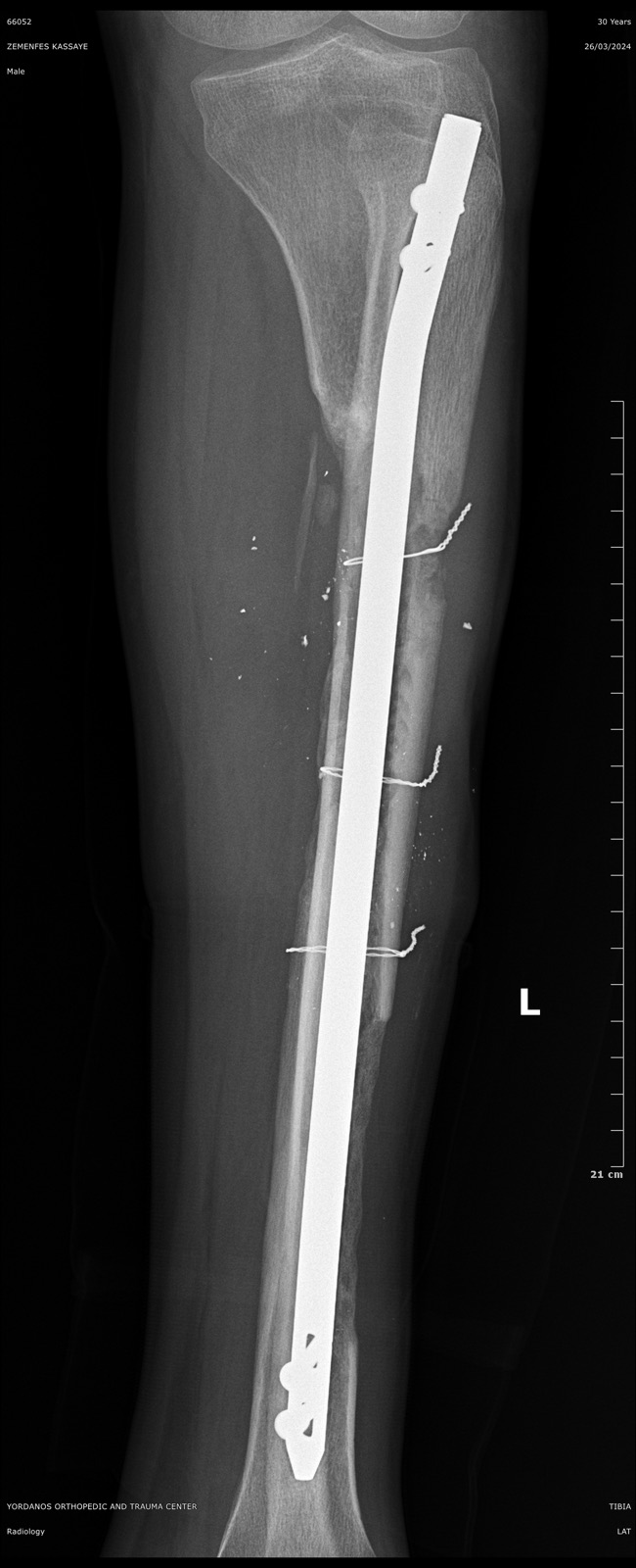 Side-view X-ray of a tibia fracture fixed with an intramedullary nail