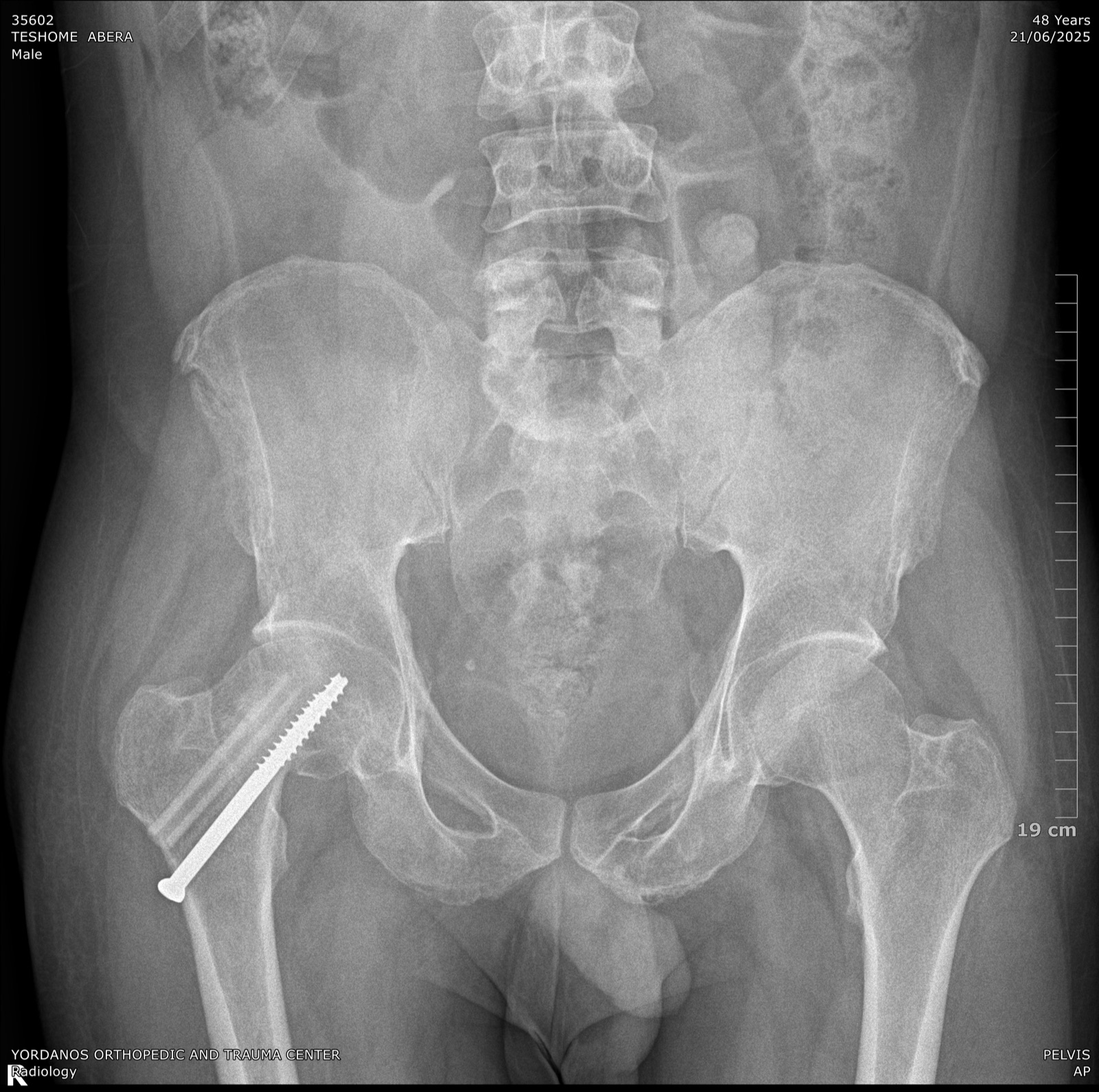 X-ray of a hip fracture stabilized with a cannulated screw