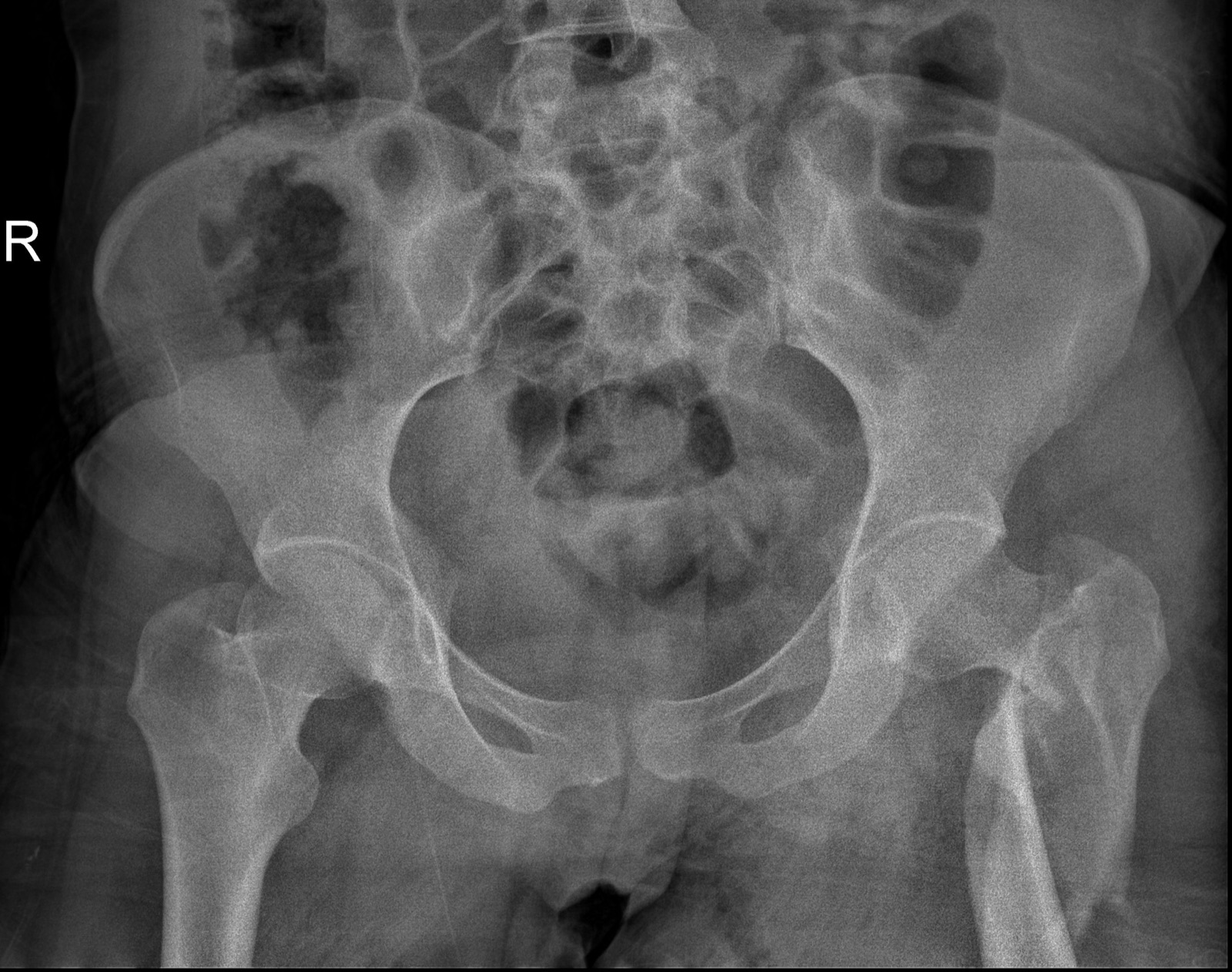 X-ray of the pelvis and hip joints