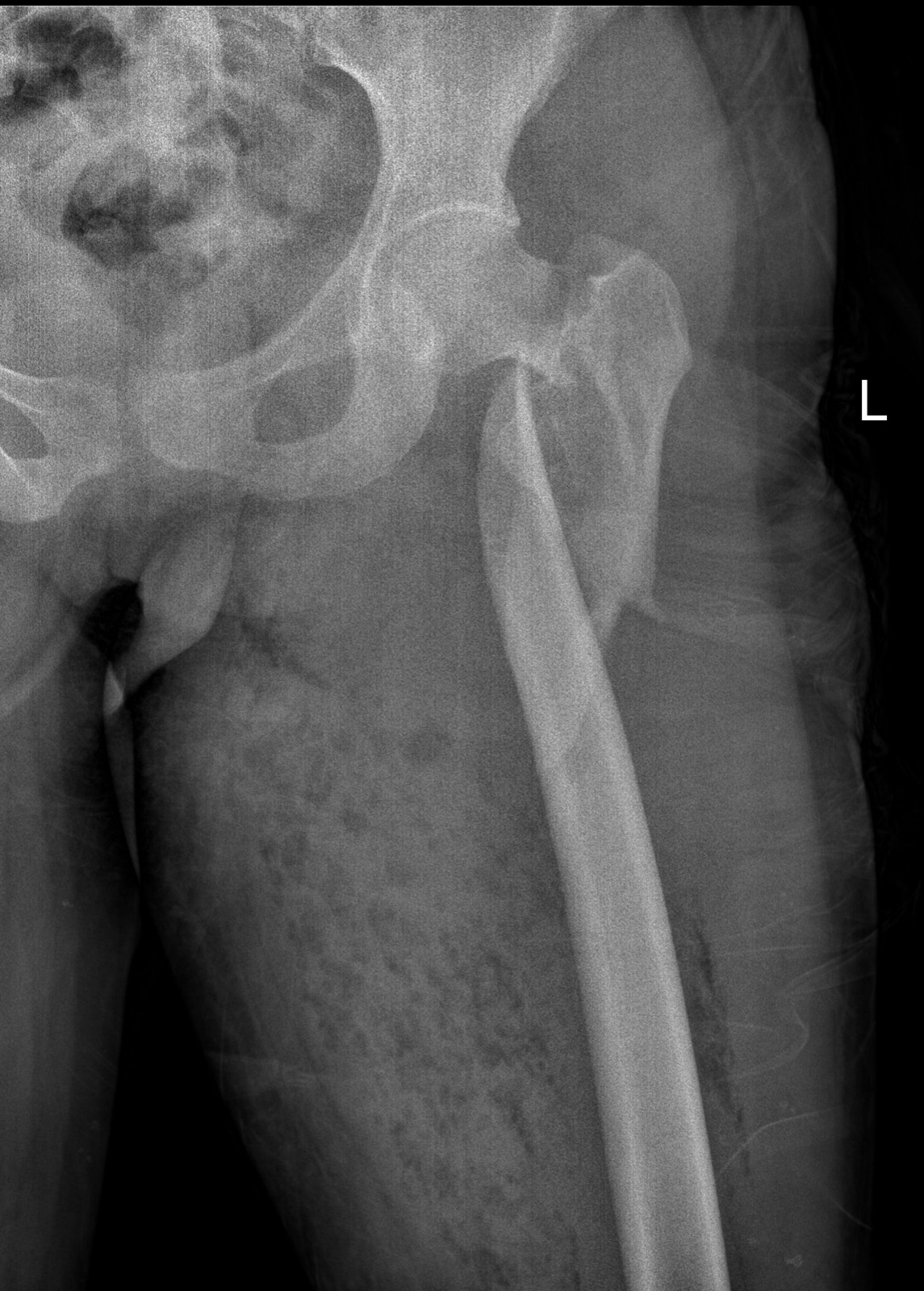 X-ray of a femur reconstruction using an intramedullary rod