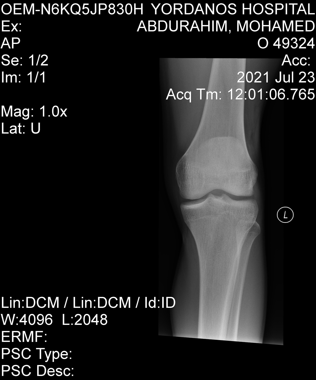 Knee joint X-ray before ACL reconstruction surgery