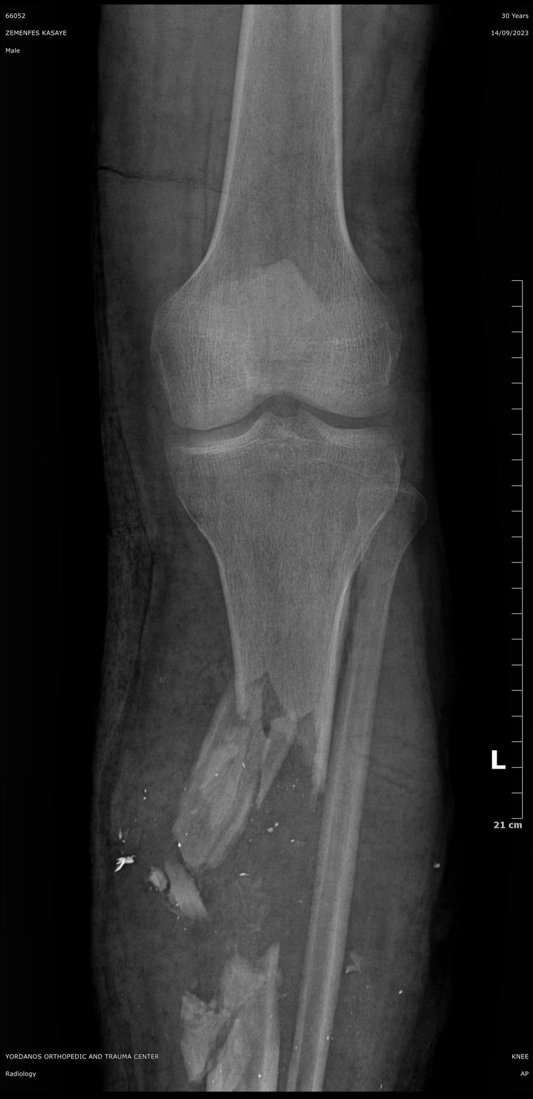 X-ray showing external fixation of a tibia fracture, front view