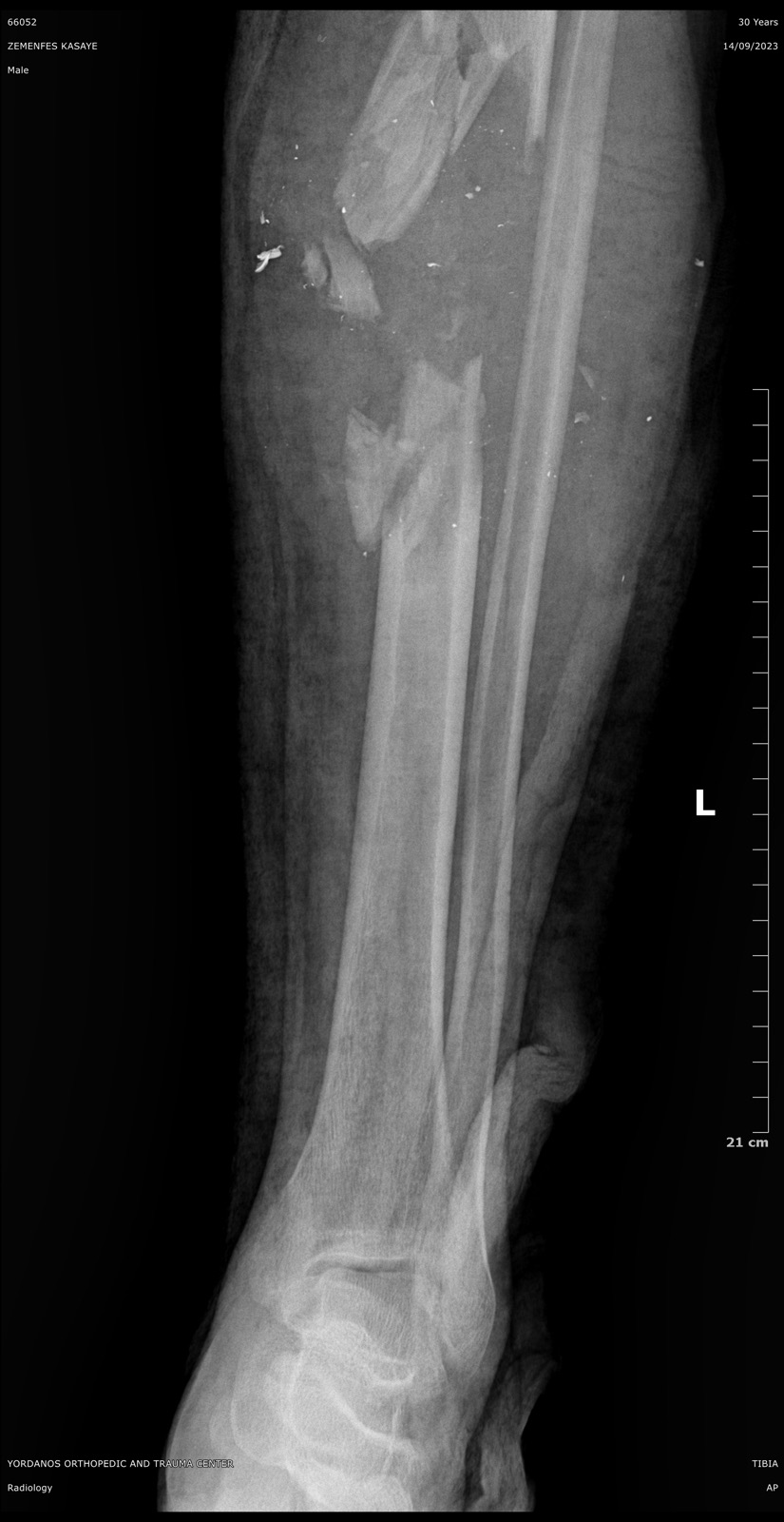 X-ray of a severe tibia and fibula shaft fracture prior to surgical fixation